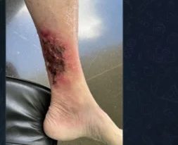 Imagem da perna de Bolsonaro é divulgada e impressiona: ”Erisipela desenvolvida”